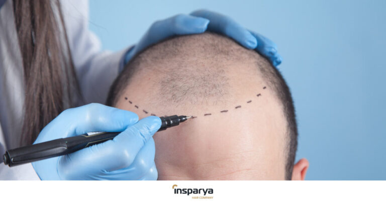 trapianto di capelli in turchia