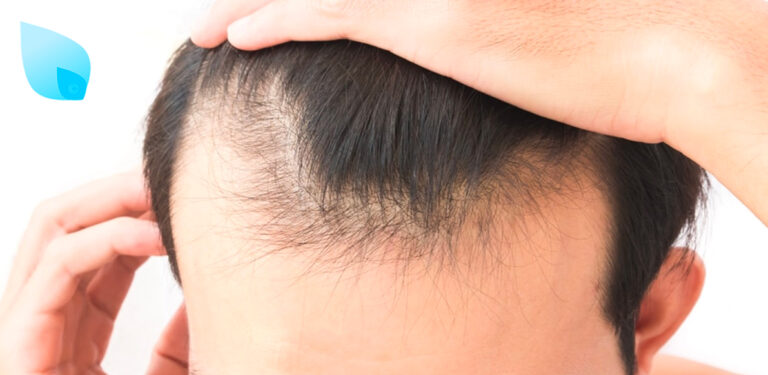 calvizie giovanile rimedi